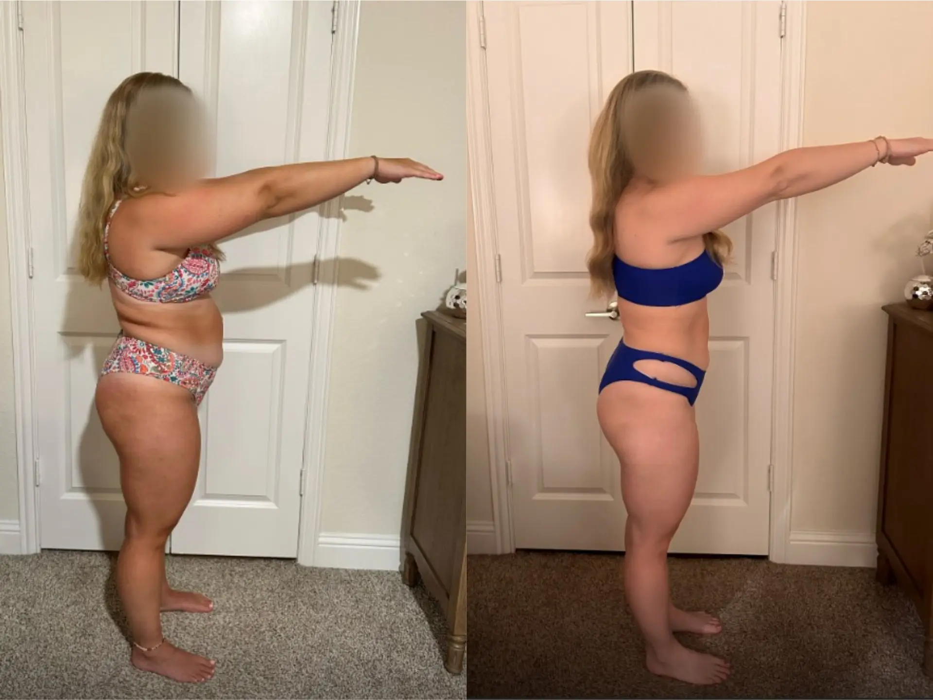 Before and after photos of Lily R, Side, before and after