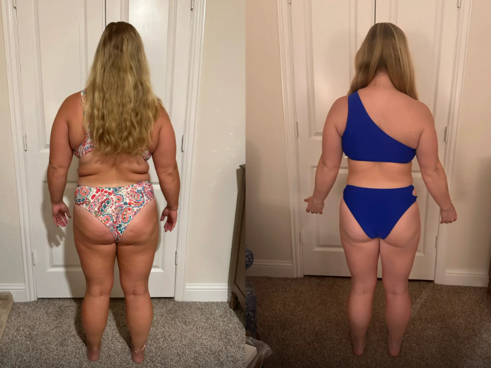 Before and after photos of Lily R, Back, before and after